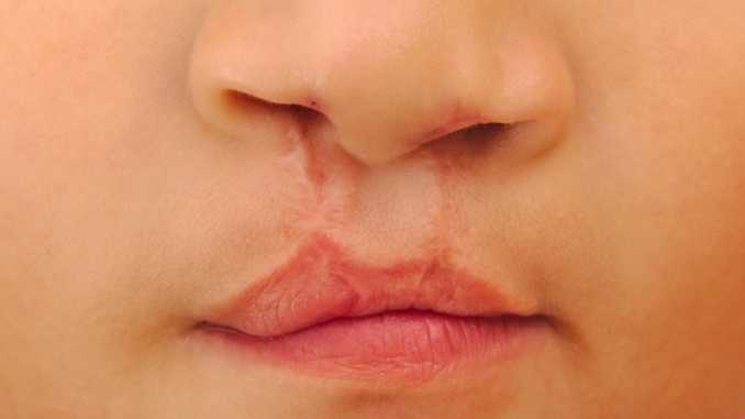 labio leporino